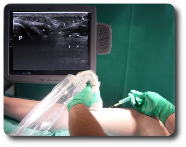 Leczenie kolana skoczka iniekcją celowaną ultrasonograficznie